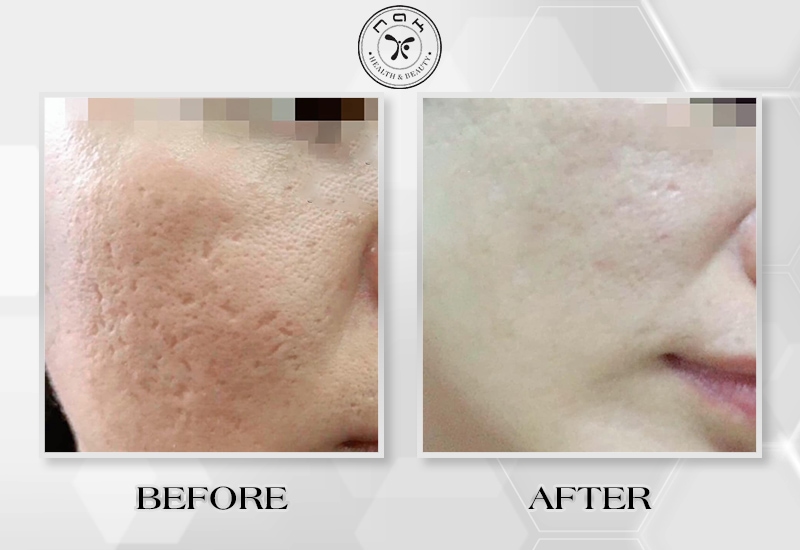 Before and after treatment