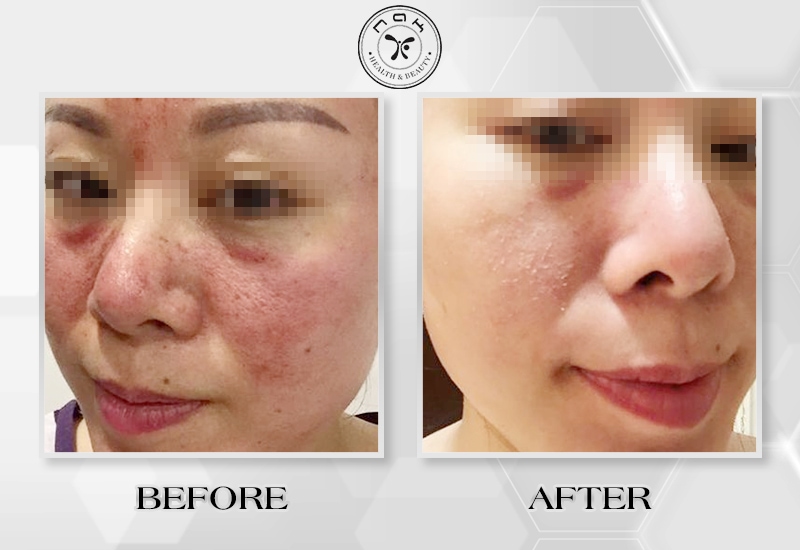 Before and after treatment
