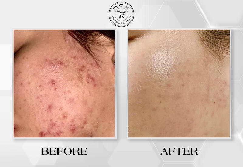 Before and after treatment