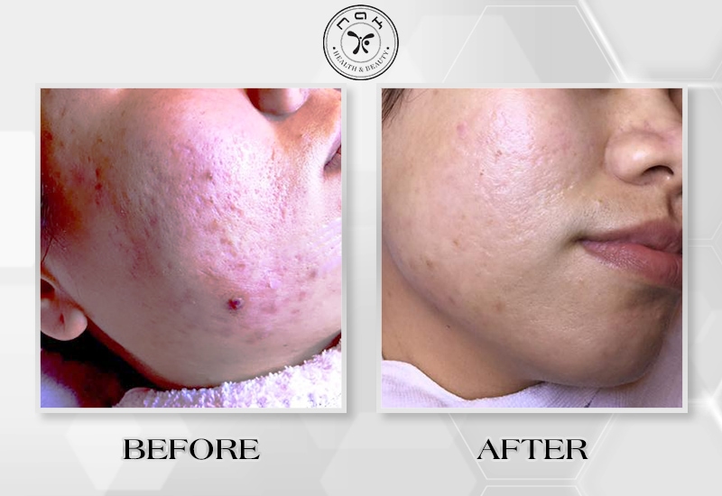 Before and after treatment
