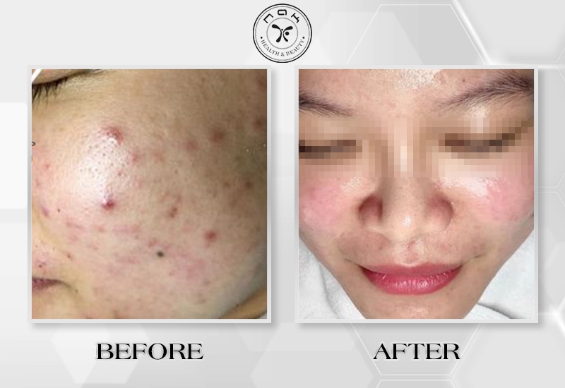 Before and after treatment